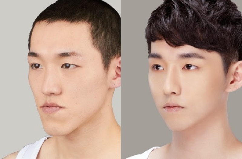 Chi phí định hình khuôn mặt siêu hấp dẫn với nhiều ưu đãi