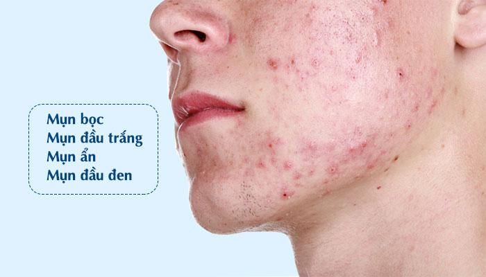 Công nghệ Ultra Skin được thiết kế đặc biệt để giải quyết tất cả các loại mụn