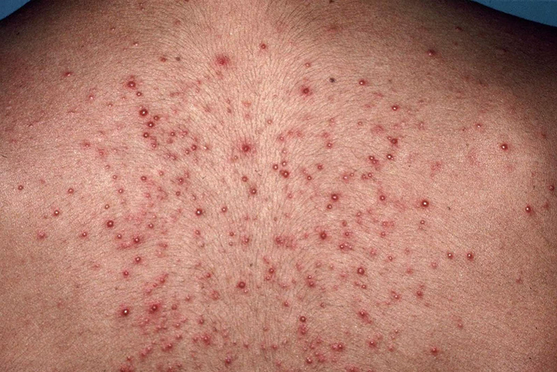 Đội ngũ nhân viên chuyên nghiệp đảm bảo trị viêm nang lông nam an toàn 