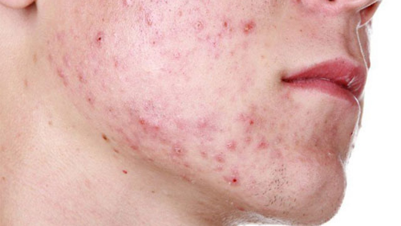 Lấy nhân mụn là bước quan trọng trong buổi điều trị mụn cho nam 