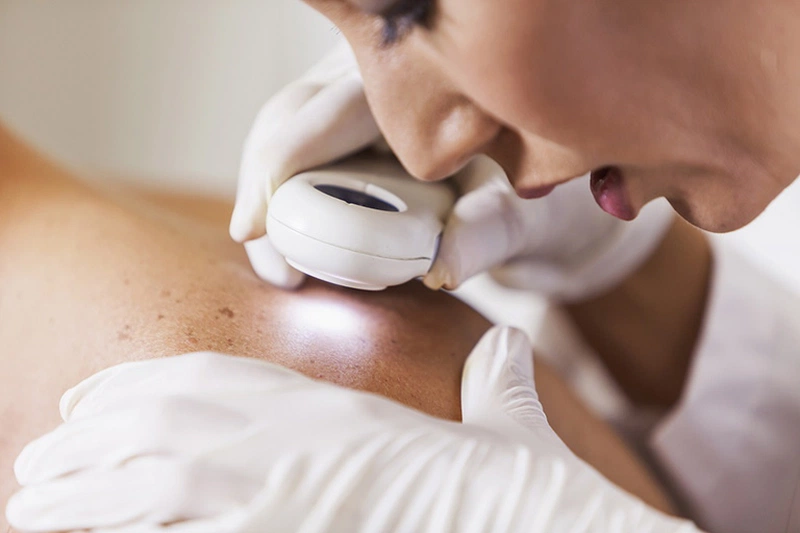 Trị viêm nang lông bằng laser rất an toàn, không đau, cho hiệu quả cao