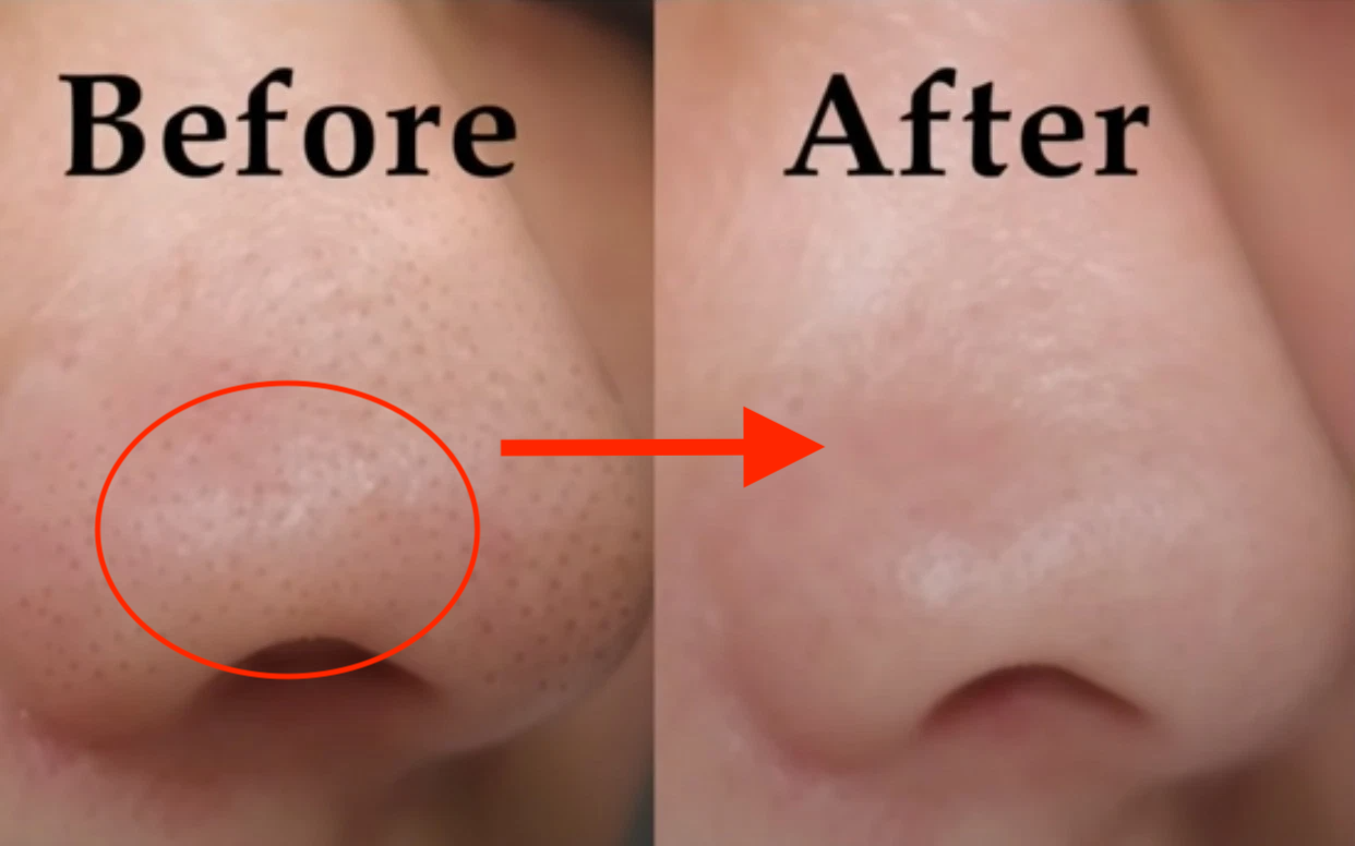 Một ví dụ trước và sau khi trị mụn đầu đen nam 