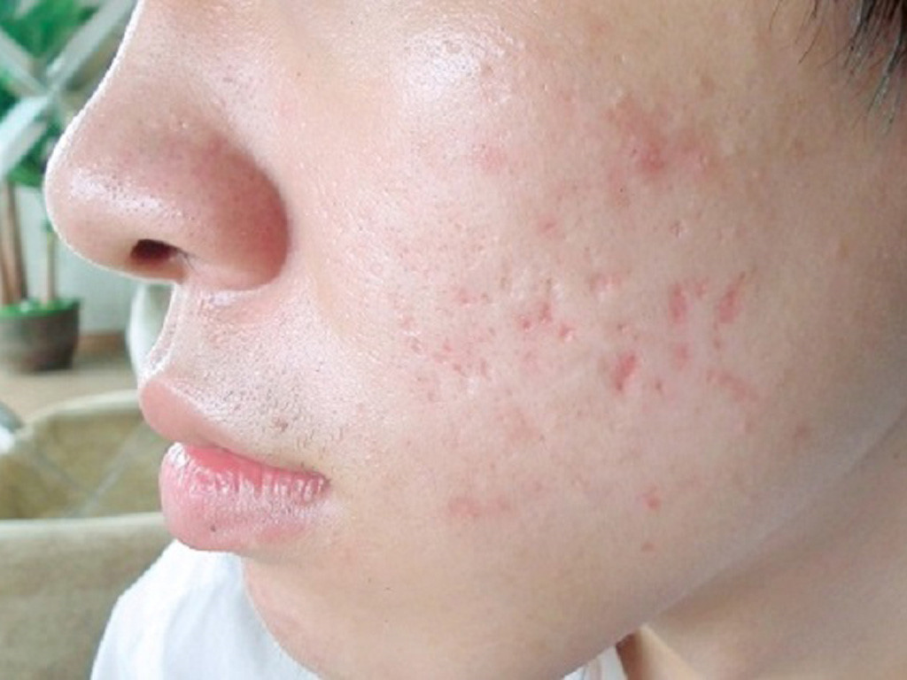 Sẹo rỗ ở nam giới sau khi điều trị mụn trứng cá