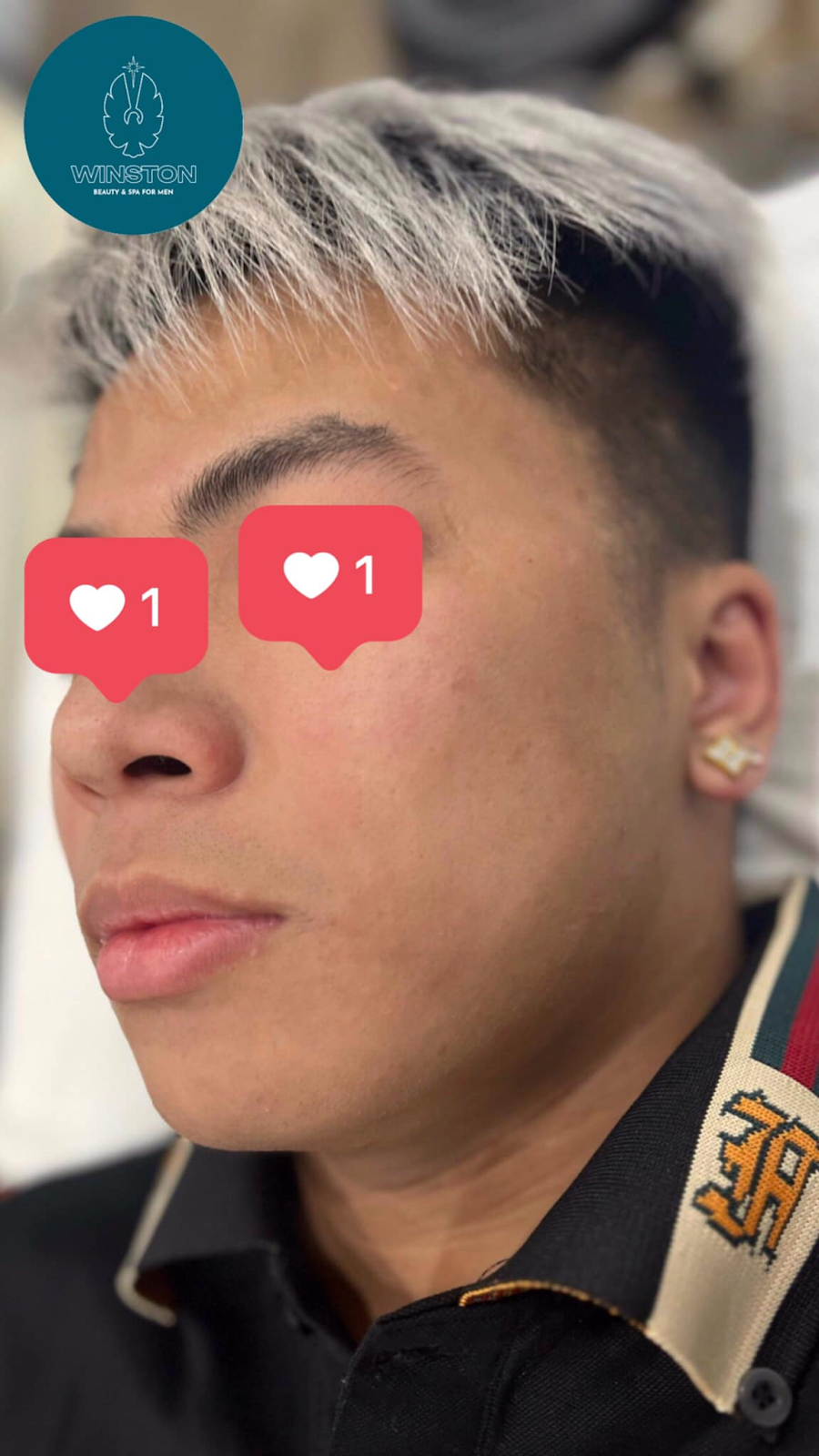 Một khách hàng sử dụng dịch vụ trị sẹo rỗ cho nam tại Winston