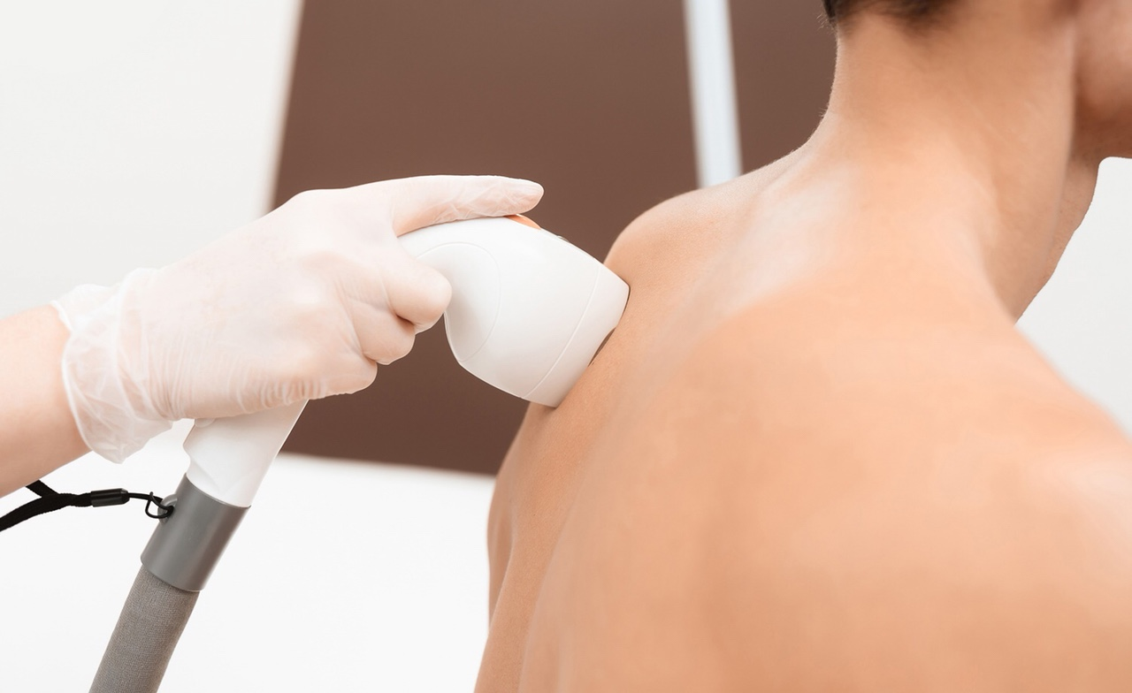 Triệt lông nam không đau áp dụng được trên toàn bộ cơ thể 