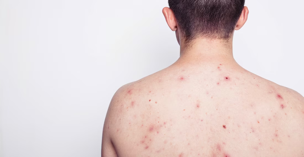 Mụn lưng nam gây đau rát và ngứa ngáy khó chịu cho người mắc phải 