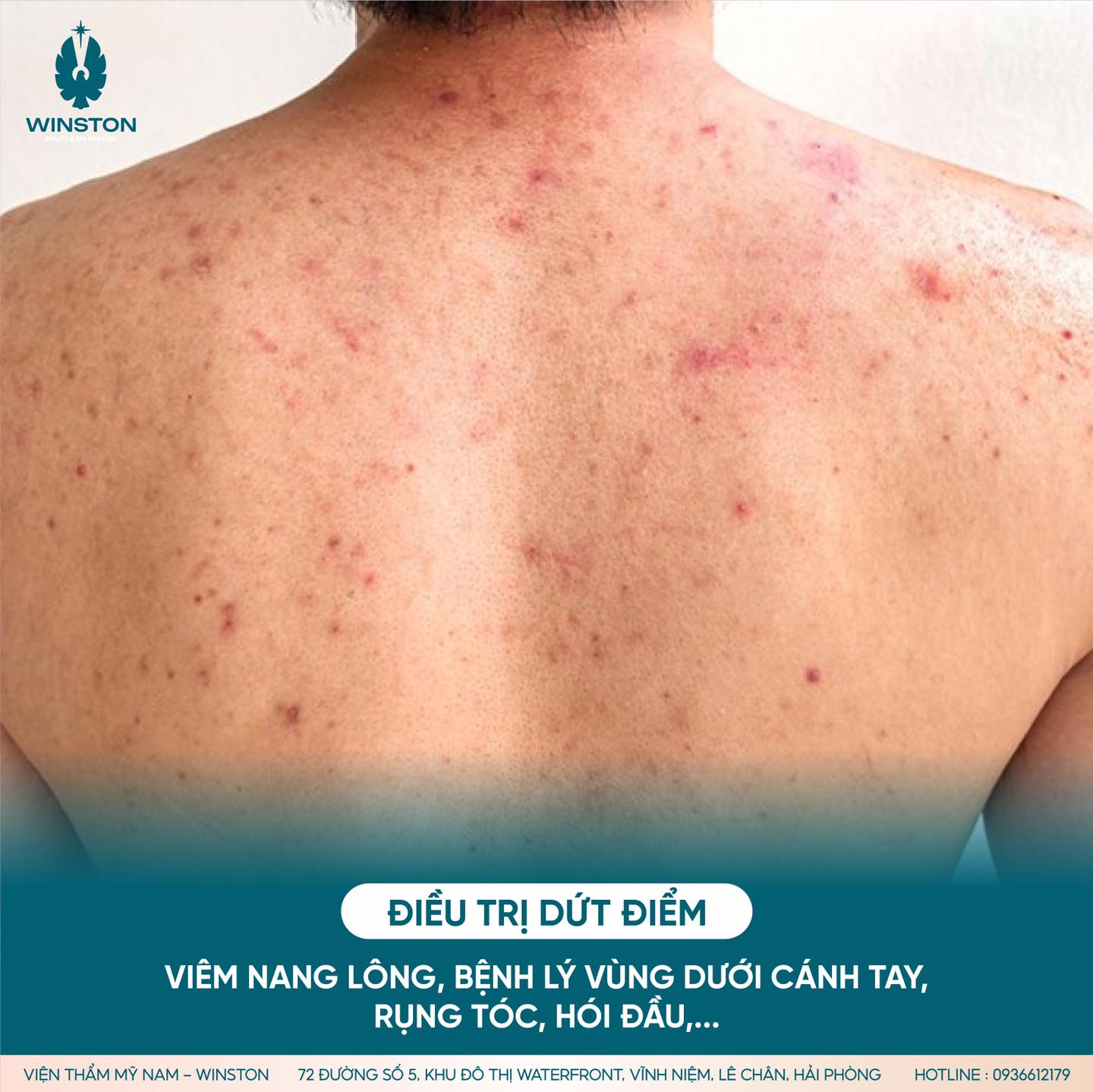 Thẩm mỹ nam Winston có các gói điều trị mụn lưng nam dứt điểm, không tái phát