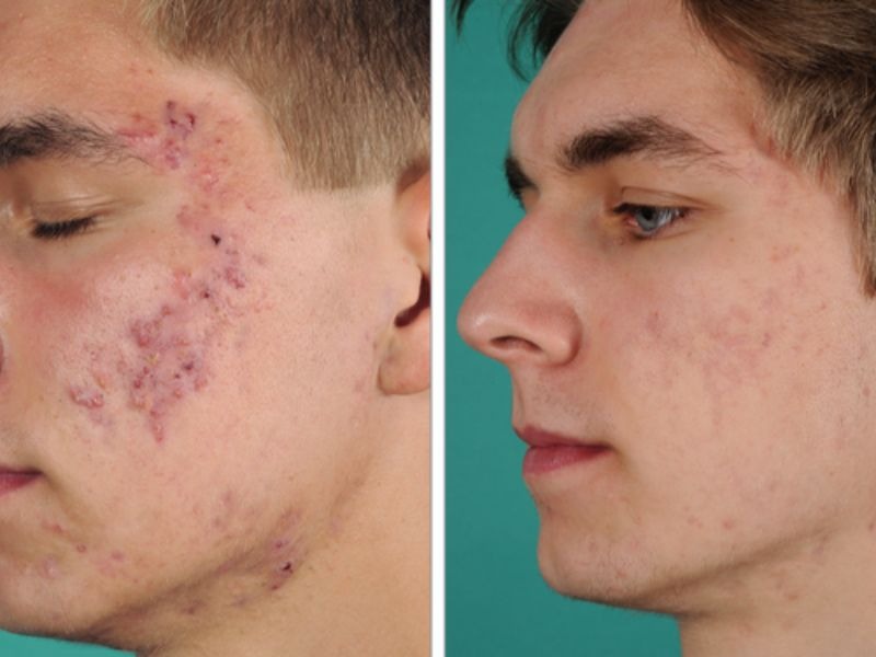 Trị thâm mụn cho nam có phức tạp không? 