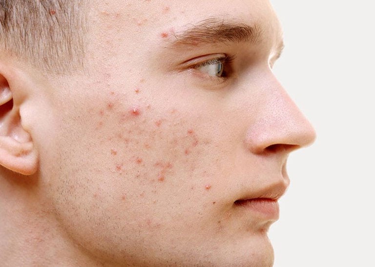 Thâm mụn là gì? 