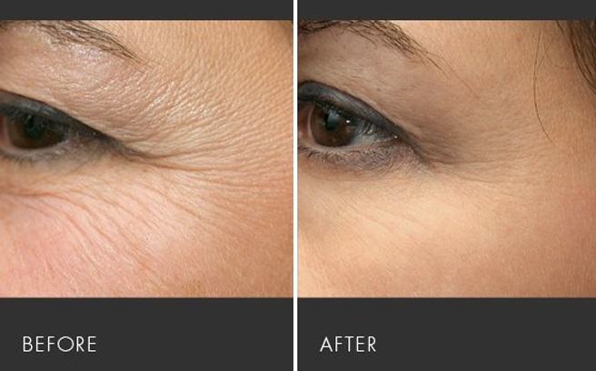 Xoá nhăn mắt nam bằng căng chỉ 