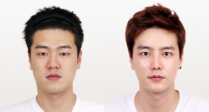 Dùng sóng siêu âm nâng cơ xóa nọng cằm nam 