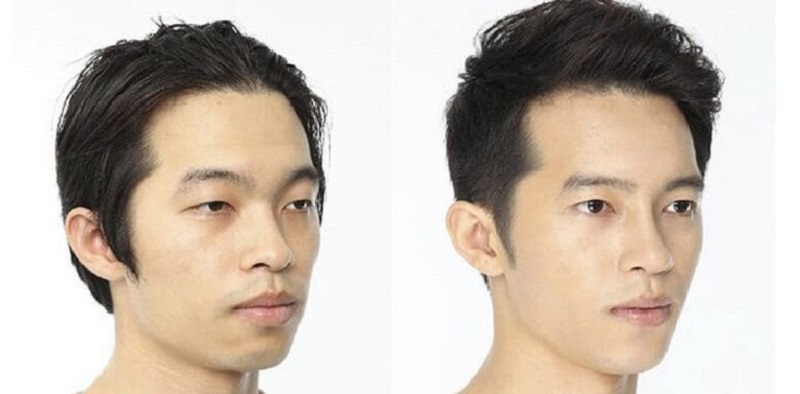 Bật mí hai phương pháp xoá nọng cằm nam không xâm lấn và an toàn