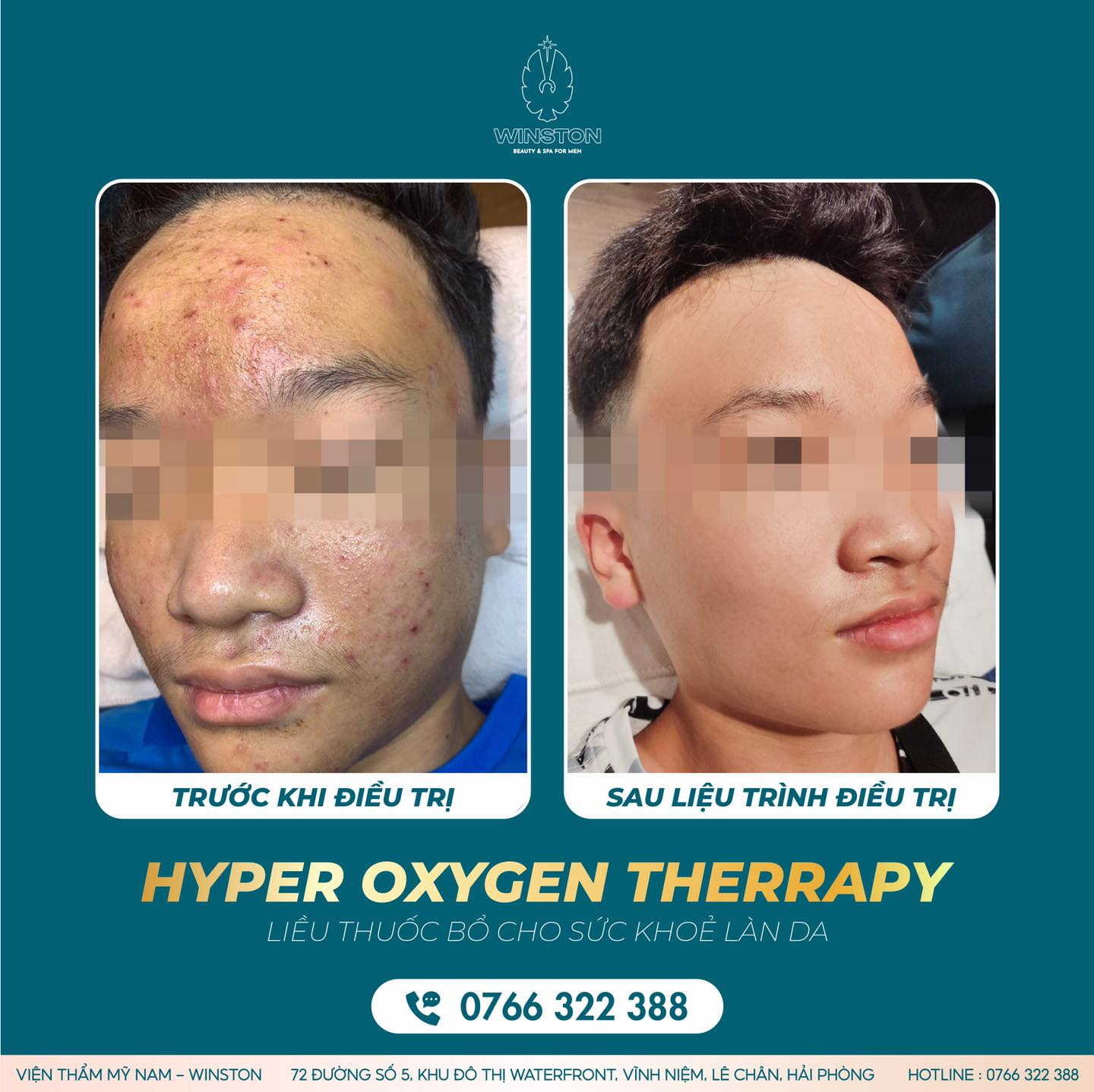 Viện Thẩm Mỹ Nam Winston Hải Phòng điều trị mụn cho nam