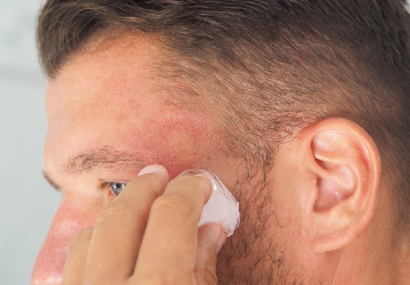 Trị mụn dị ứng bằng phương pháp chườm lạnh