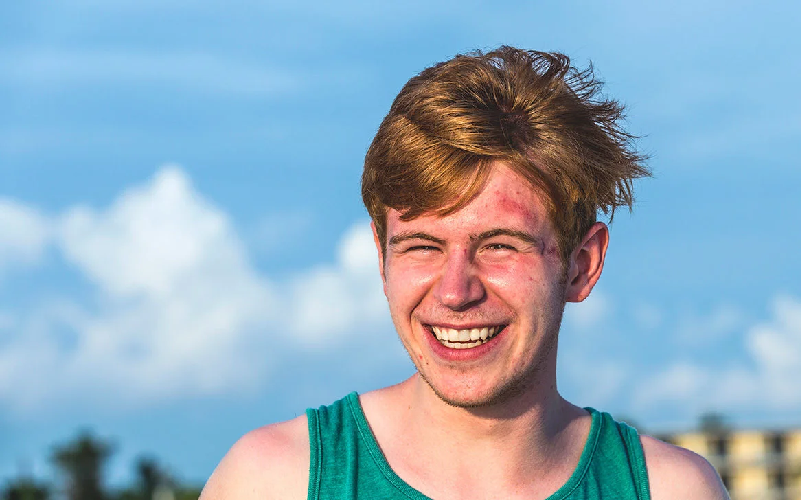 Mụn nội tiết nam do nhiều nguyên nhân gây ra