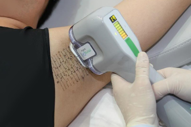 Điều trị hôi nách bẩm sinh bằng hút tuyến mồ hôi nách