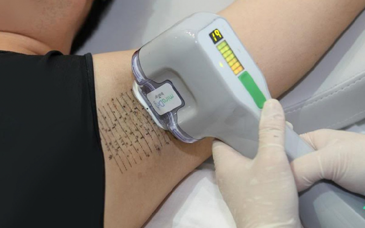 Trị hôi nách dứt điểm cho nam giới bằng công nghệ MiraDry