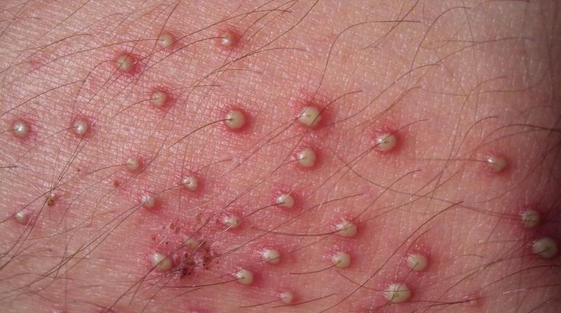 Viêm nang lông ở nam giới cần điều trị đúng cách