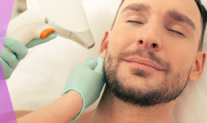 Triệt lông mặt vĩnh viễn cho nam bằng laser diode