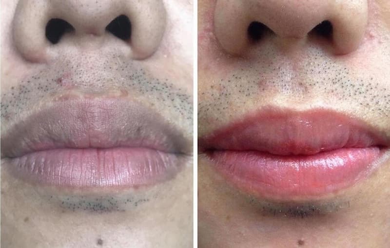 Nam giới có nên điều trị thâm môi không? Giải pháp phù hợp