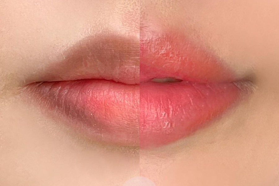 Viện thẩm mỹ nam Winston Hải Phòng giúp khử thâm môi nam giới hiệu quả