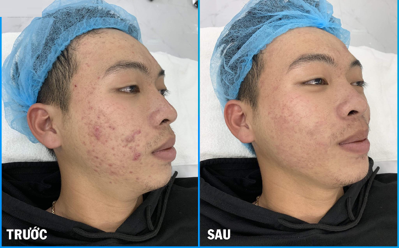 Viện Thẩm Mỹ Nam Winston Hải Phòng nhận trị mụn đầu đen hiệu quả