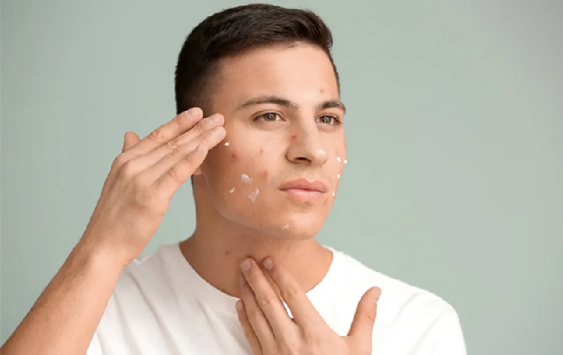 Trị mụn viêm mủ nam giới nên chọn dùng thuốc