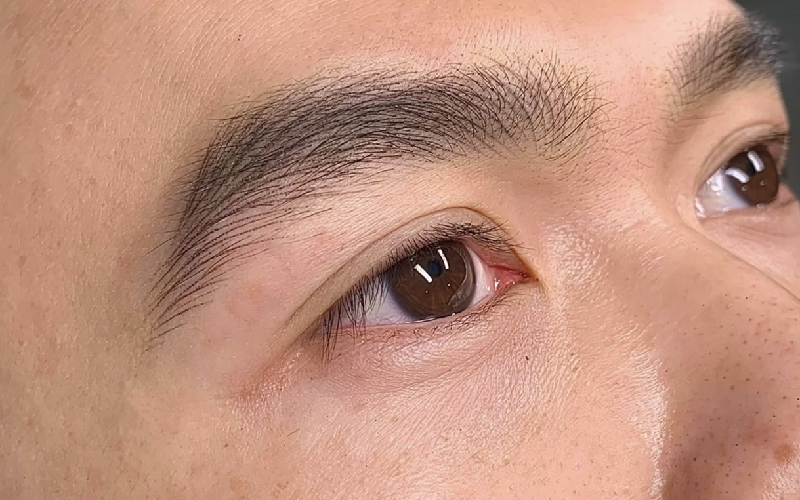 Xóa mày hỏng nam giới nên chọn Viện thẩm mỹ Nam WINSTON