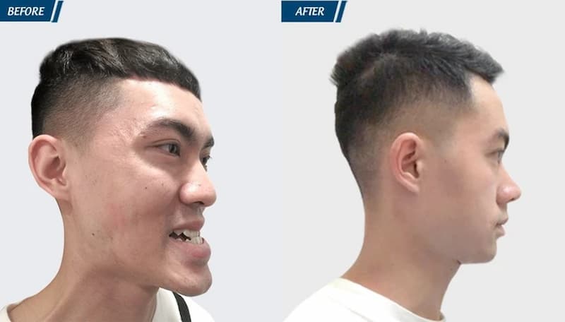 Nếu có khuôn mặt hàm bạnh bạn nên chọn thẩm mỹ cắt góc hàm