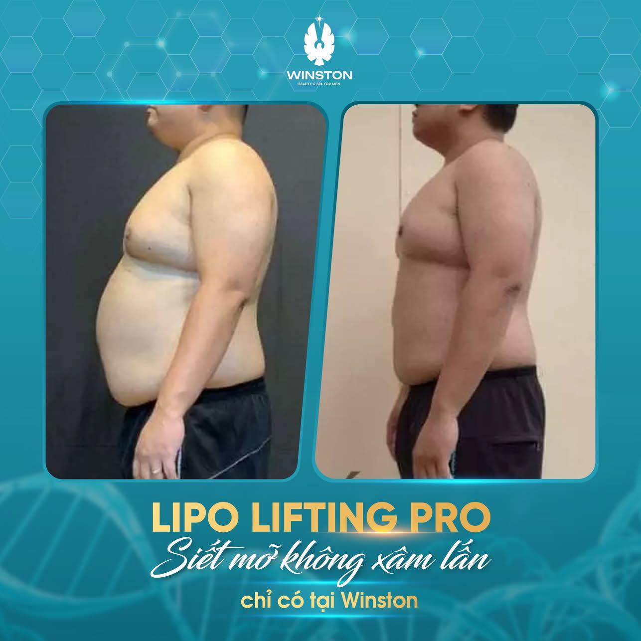 Công nghệ LIPO Lifting Pro giúp giảm béo tại Hải Phòng hiệu quả, không xâm lấn, không nghỉ dưỡng.