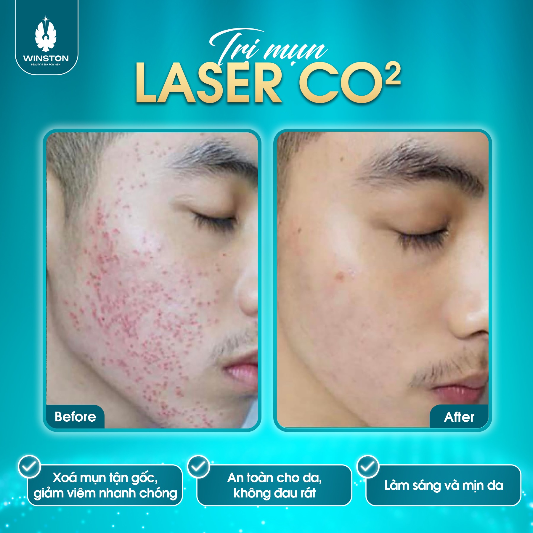 Hiệu quả khách hàng trước và sau khi thực hiện điều trị mụn bằng công nghệ Laser CO2 tại Thẩm mỹ nam Winston 
