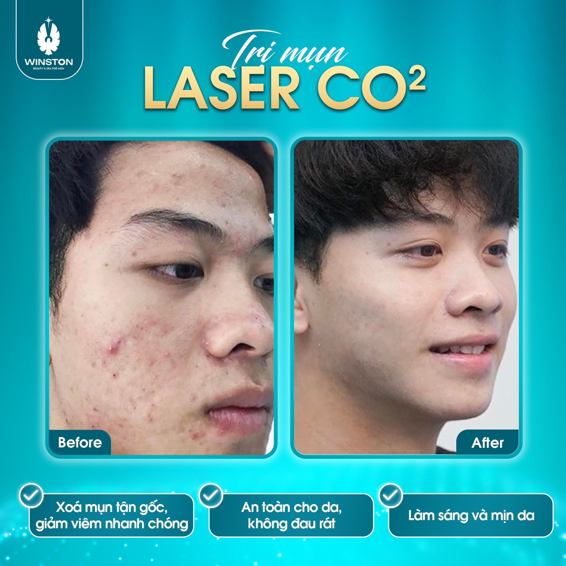 Hiệu quả khách hàng trước và sau khi thực hiện điều trị mụn bằng công nghệ Laser CO2 tại Thẩm mỹ nam Winston 