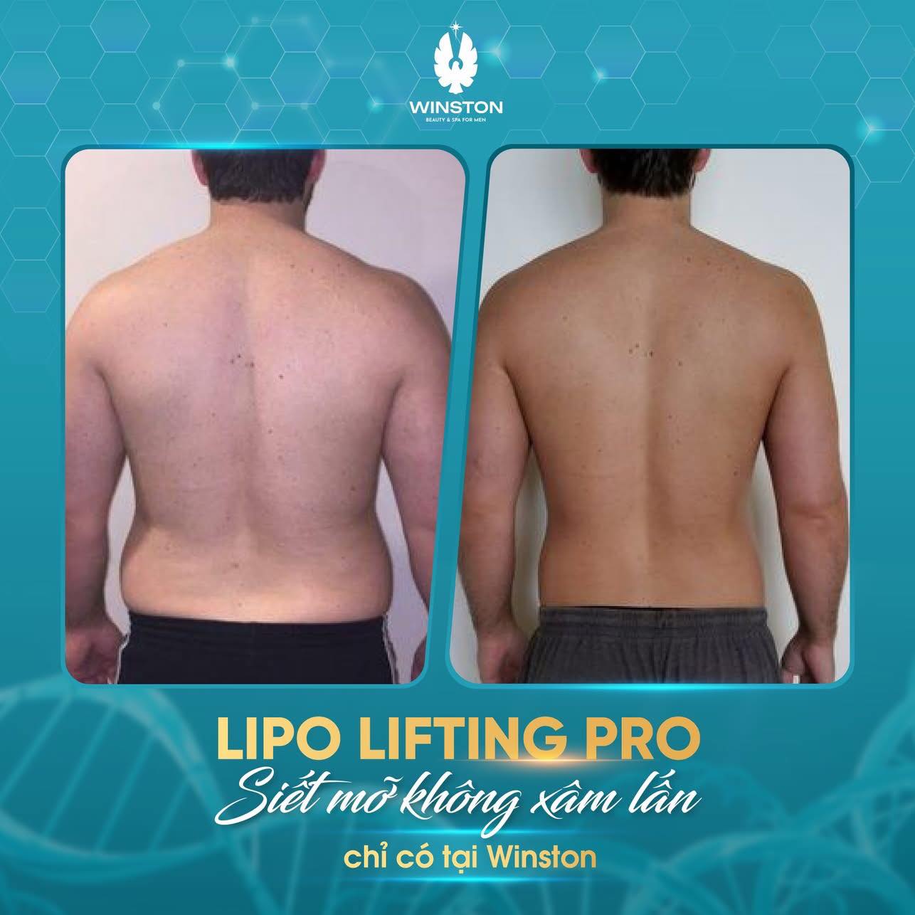 Hình ảnh thực tế của khách hàng sử dụng công nghệ LIPO Lifting Pro tại TMV Nam Winston.