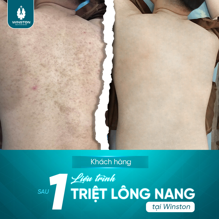 triệt lông cho nam tại Hải Phòng 4