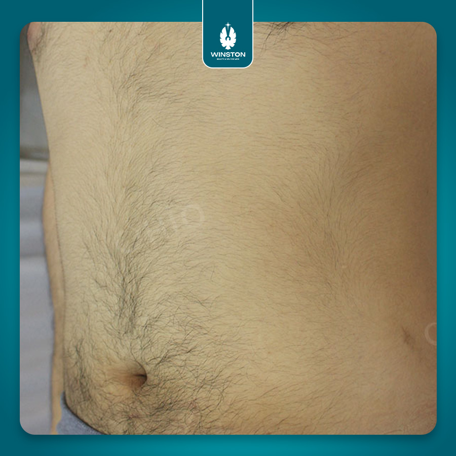 Công nghệ hủy lông sinh học SHR - Nhanh – an toàn – phù hợp với cả làn da nhạy cảm