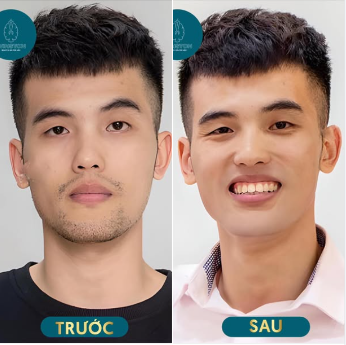 Công nghệ triệt lông tại TMN Winston giải quyết vùng râu quai nón mọc quá nhiều quá rậm, quá đen quá cứng